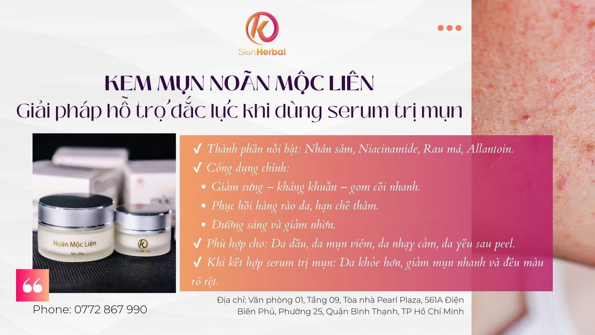 Kem mụn No&atilde;n Mộc Li&ecirc;n - Giải ph&aacute;p hỗ trợ đắc lực khi d&ugrave;ng serum trị mụn